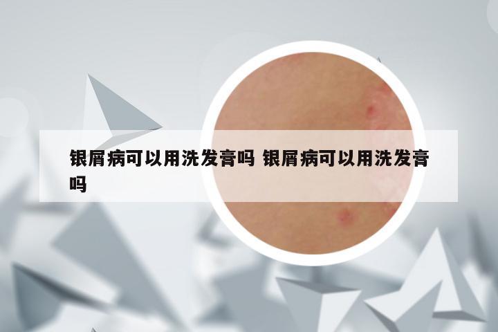 银屑病可以用洗发膏吗 银屑病可以用洗发膏吗