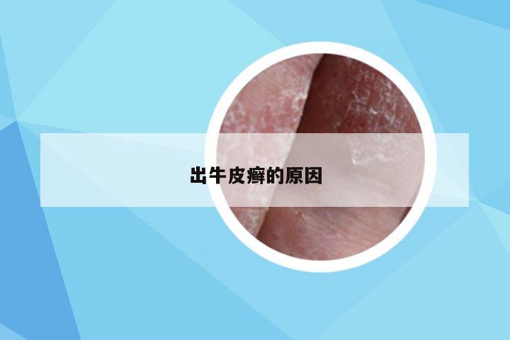 出牛皮癣的原因