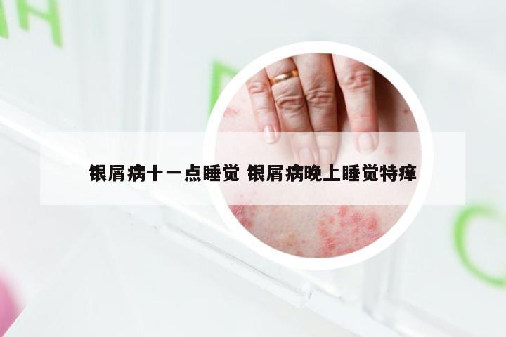 银屑病十一点睡觉 银屑病晚上睡觉特痒