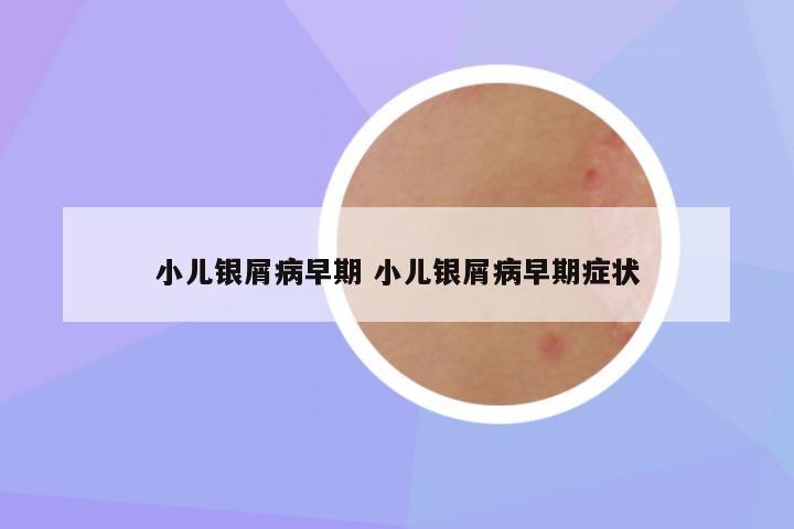 小儿银屑病早期 小儿银屑病早期症状