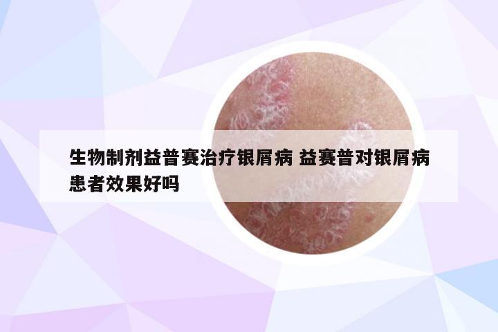 生物制剂益普赛治疗银屑病 益赛普对银屑病患者效果好吗