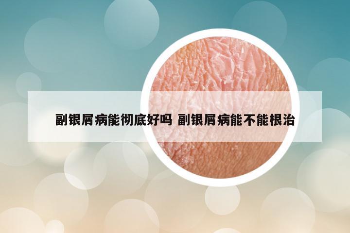 副银屑病能彻底好吗 副银屑病能不能根治