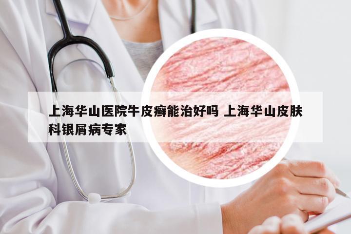 上海华山医院牛皮癣能治好吗 上海华山皮肤科银屑病专家