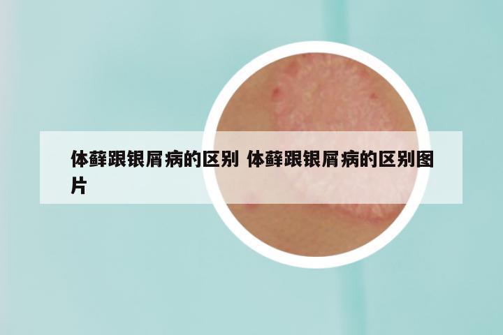 体藓跟银屑病的区别 体藓跟银屑病的区别图片