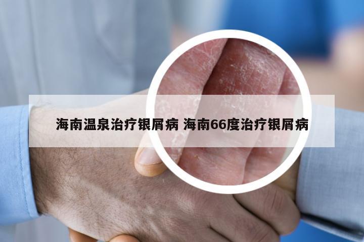 海南温泉治疗银屑病 海南66度治疗银屑病