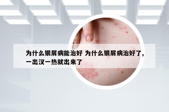 为什么银屑病能治好 为什么银屑病治好了,一出汉一热就出来了