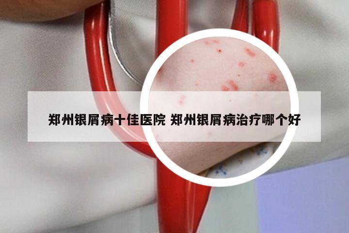 郑州银屑病十佳医院 郑州银屑病治疗哪个好