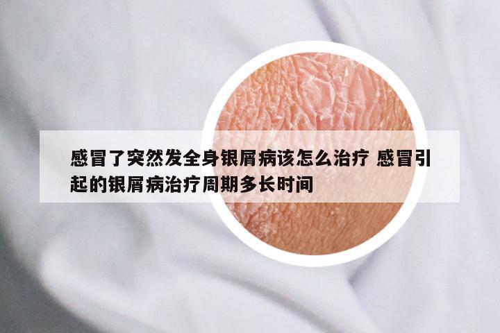 感冒了突然发全身银屑病该怎么治疗 感冒引起的银屑病治疗周期多长时间