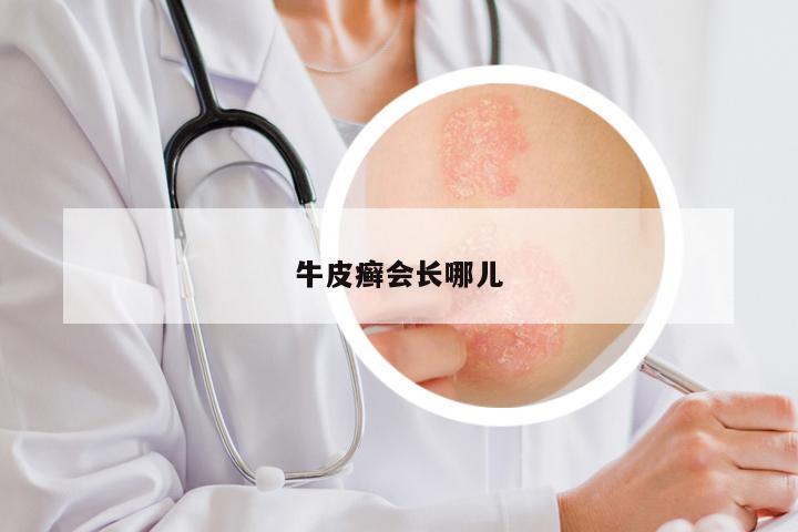 牛皮癣会长哪儿