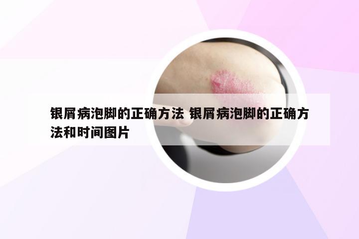 银屑病泡脚的正确方法 银屑病泡脚的正确方法和时间图片