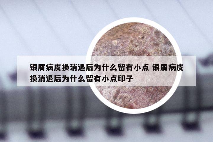 银屑病皮损消退后为什么留有小点 银屑病皮损消退后为什么留有小点印子