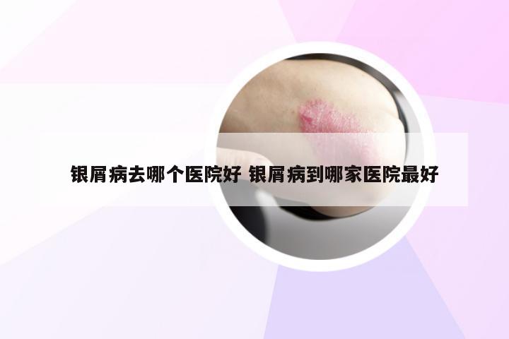 银屑病去哪个医院好 银屑病到哪家医院最好