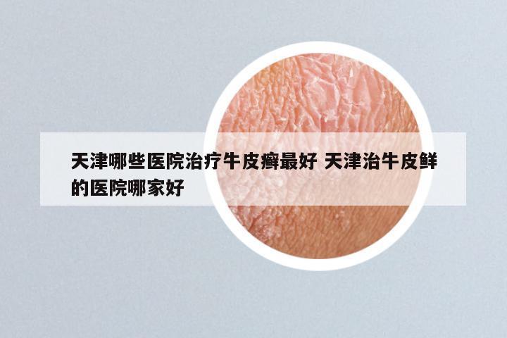 天津哪些医院治疗牛皮癣最好 天津治牛皮鲜的医院哪家好
