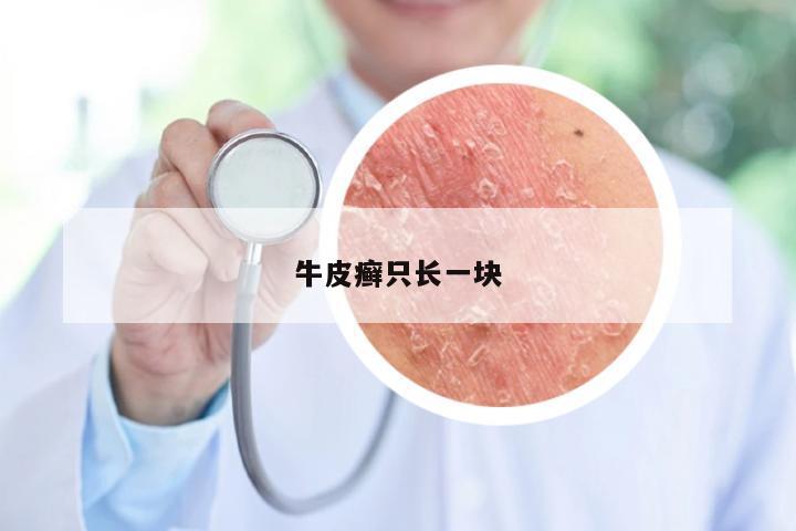 牛皮癣只长一块
