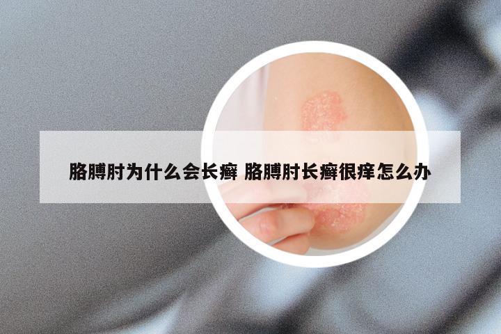 胳膊肘为什么会长癣 胳膊肘长癣很痒怎么办