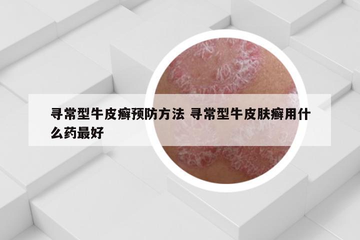 寻常型牛皮癣预防方法 寻常型牛皮肤癣用什么药最好
