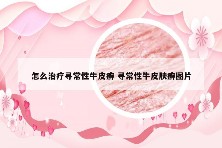 怎么治疗寻常性牛皮癣 寻常性牛皮肤癣图片