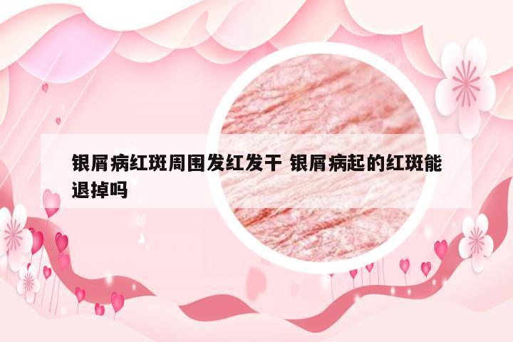 银屑病红斑周围发红发干 银屑病起的红斑能退掉吗