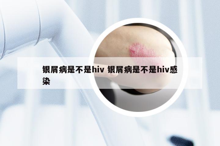 银屑病是不是hiv 银屑病是不是hiv感染