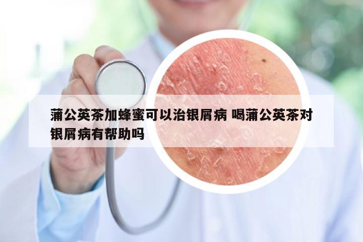 蒲公英茶加蜂蜜可以治银屑病 喝蒲公英茶对银屑病有帮助吗