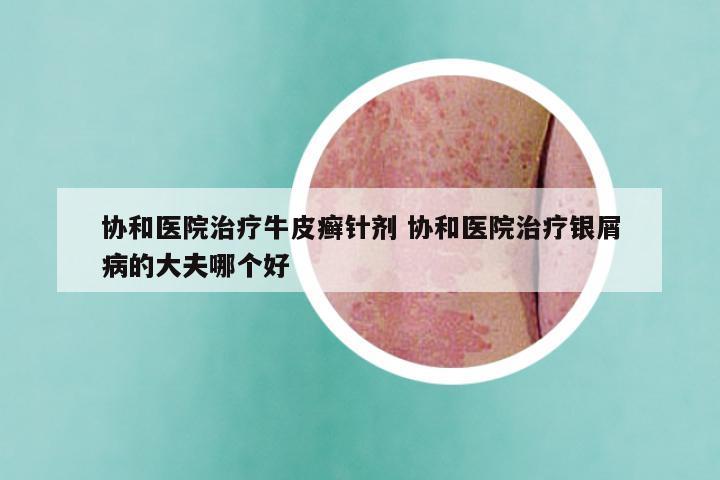协和医院治疗牛皮癣针剂 协和医院治疗银屑病的大夫哪个好