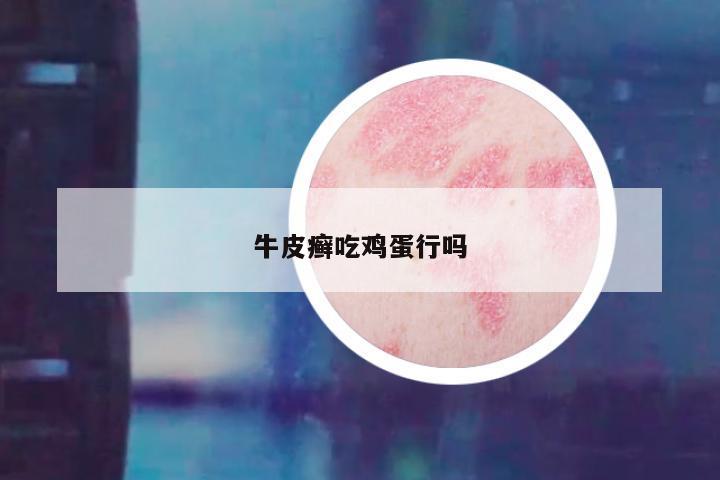 牛皮癣吃鸡蛋行吗