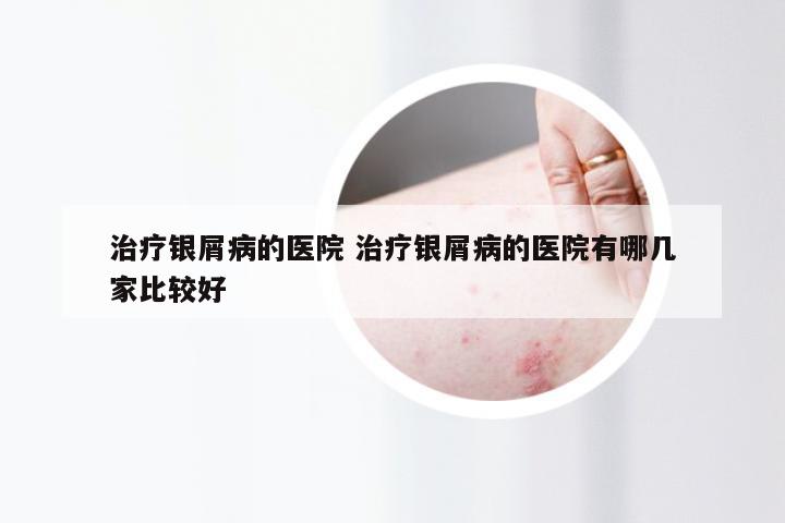 治疗银屑病的医院 治疗银屑病的医院有哪几家比较好