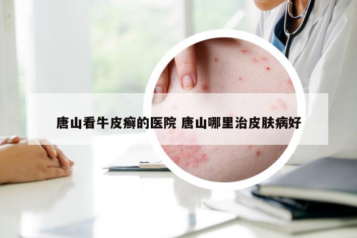 唐山看牛皮癣的医院 唐山哪里治皮肤病好