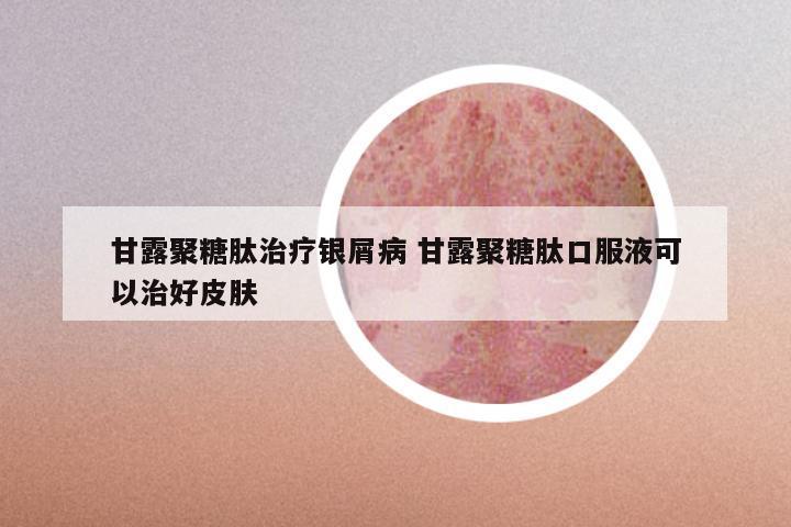甘露聚糖肽治疗银屑病 甘露聚糖肽口服液可以治好皮肤