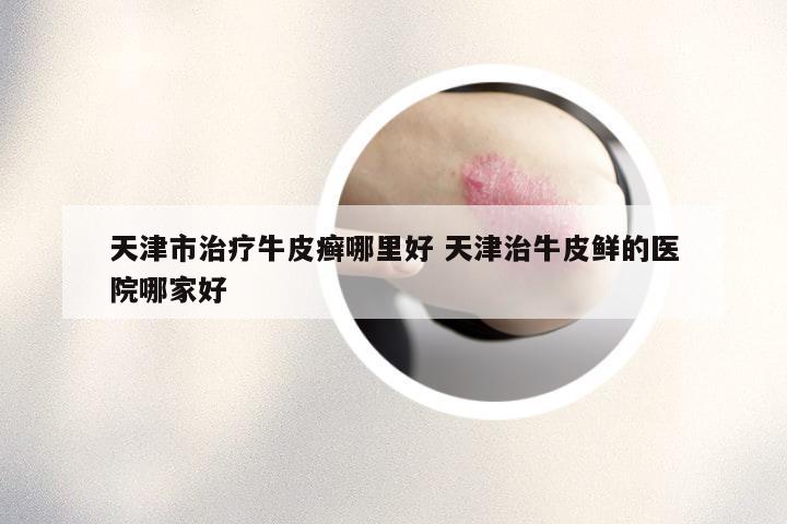 天津市治疗牛皮癣哪里好 天津治牛皮鲜的医院哪家好