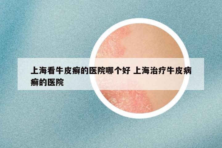 上海看牛皮癣的医院哪个好 上海治疗牛皮病癣的医院