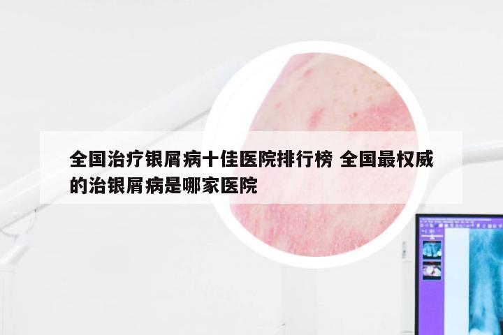 全国治疗银屑病十佳医院排行榜 全国最权威的治银屑病是哪家医院