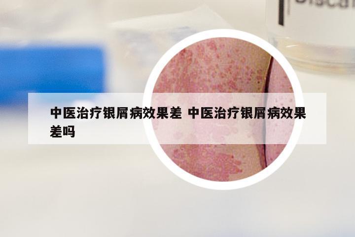 中医治疗银屑病效果差 中医治疗银屑病效果差吗