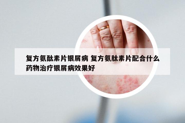 复方氨酞素片银屑病 复方氨肽素片配合什么药物治疗银屑病效果好