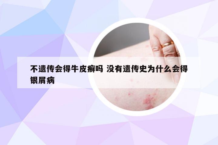 不遗传会得牛皮癣吗 没有遗传史为什么会得银屑病