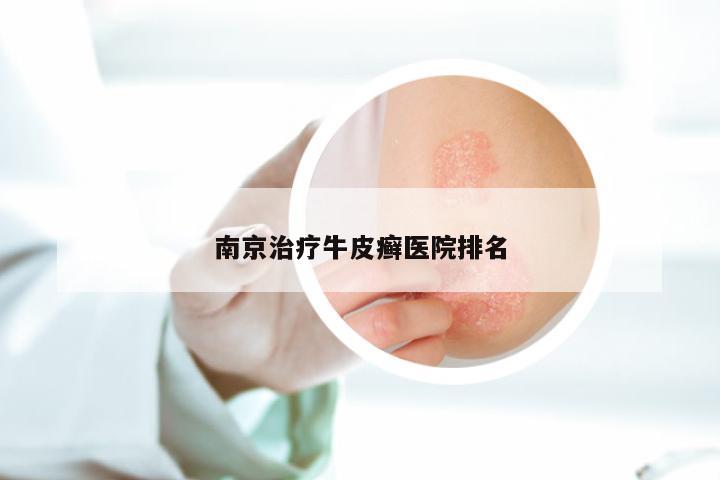 南京治疗牛皮癣医院排名