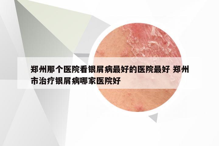 郑州那个医院看银屑病最好的医院最好 郑州市治疗银屑病哪家医院好