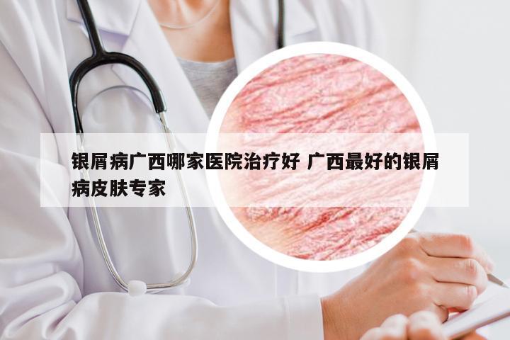 银屑病广西哪家医院治疗好 广西最好的银屑病皮肤专家