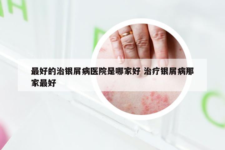 最好的治银屑病医院是哪家好 治疗银屑病那家最好