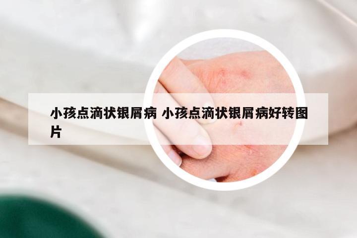小孩点滴状银屑病 小孩点滴状银屑病好转图片