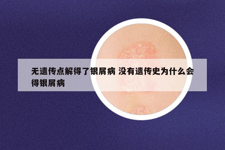 无遗传点解得了银屑病 没有遗传史为什么会得银屑病