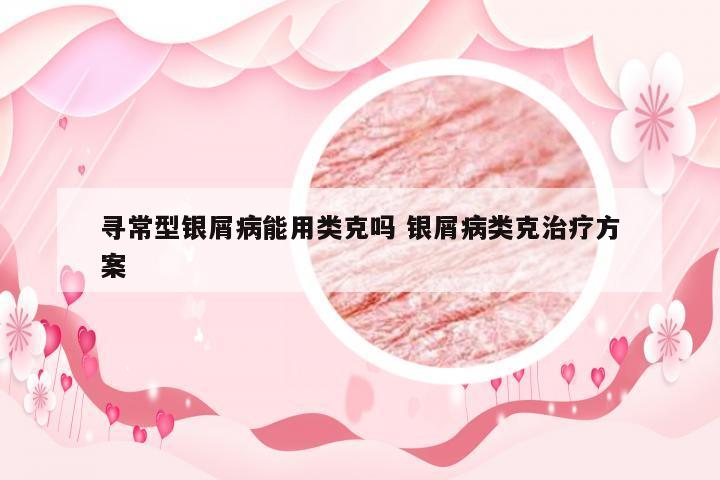 寻常型银屑病能用类克吗 银屑病类克治疗方案