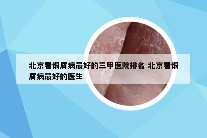 北京看银屑病最好的三甲医院排名 北京看银屑病最好的医生