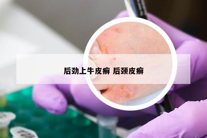 后劲上牛皮癣 后颈皮癣
