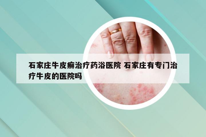 石家庄牛皮癣治疗药浴医院 石家庄有专门治疗牛皮的医院吗