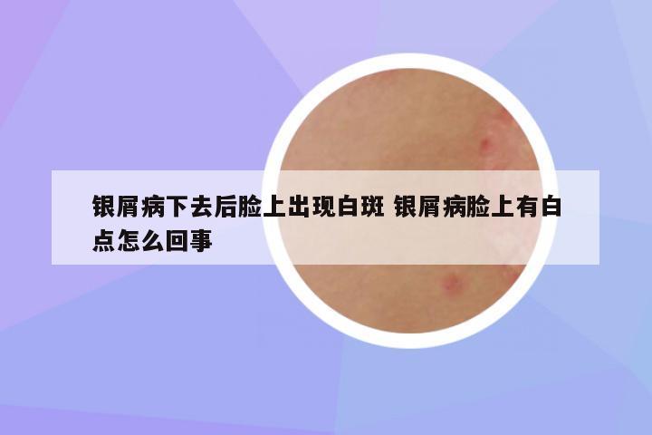 银屑病下去后脸上出现白斑 银屑病脸上有白点怎么回事