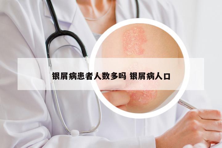 银屑病患者人数多吗 银屑病人口