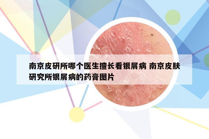 南京皮研所哪个医生擅长看银屑病 南京皮肤研究所银屑病的药膏图片