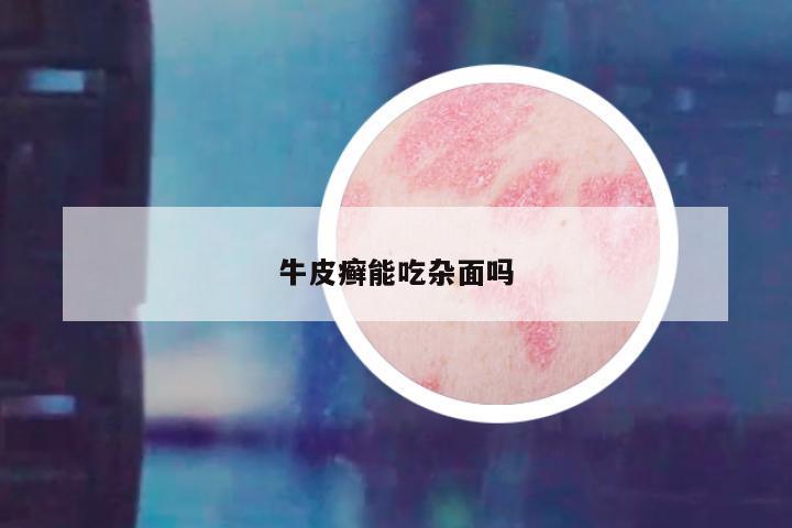 牛皮癣能吃杂面吗