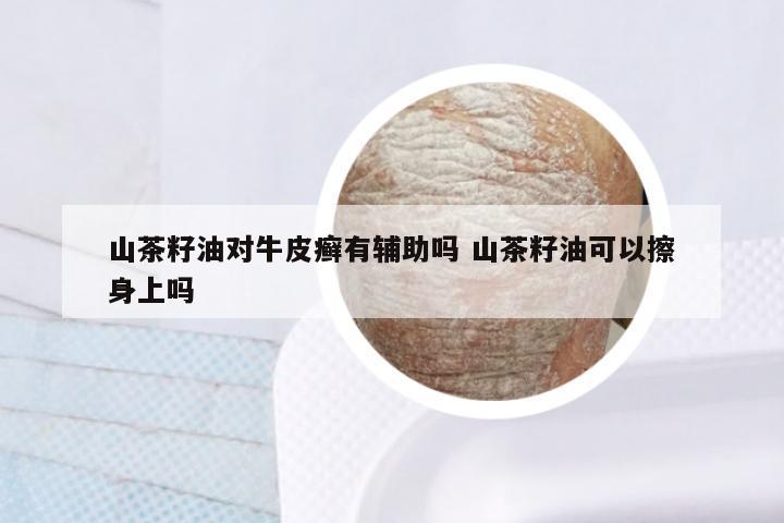 山茶籽油对牛皮癣有辅助吗 山茶籽油可以擦身上吗